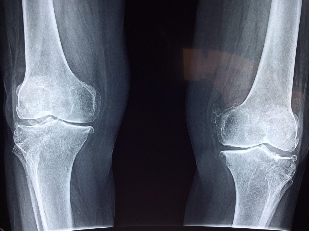 Reemplazo total de rodilla en Puerto Rico