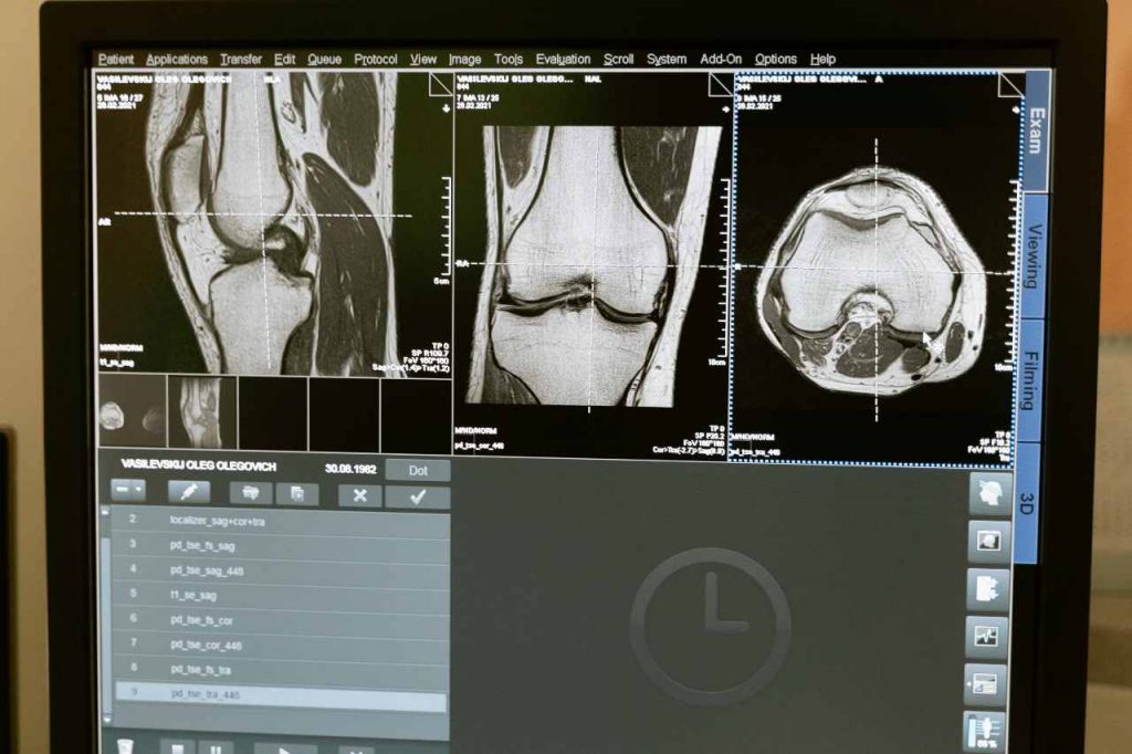cáncer en los huesos
