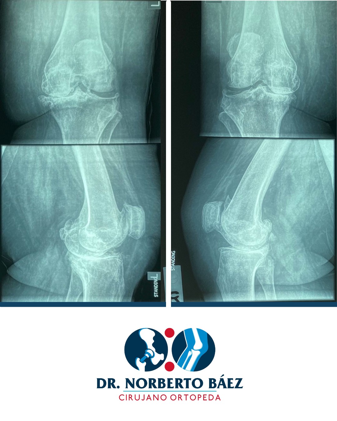 Osteoartritis de rodilla